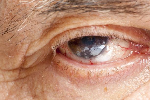 眼科疾病图片下载