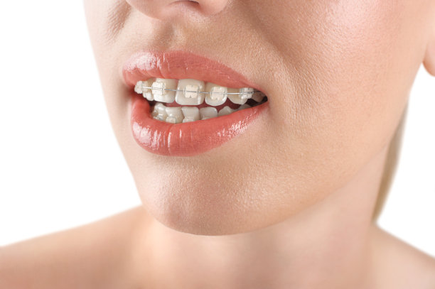 牙齿对齐。括号。美丽的女人微笑。图片下载