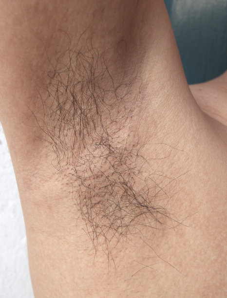 腋下有真菌病图片下载