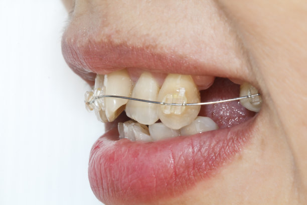 近口弯曲的牙齿与支架。图片下载