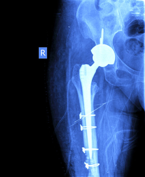 髋关节假体X光片图片下载