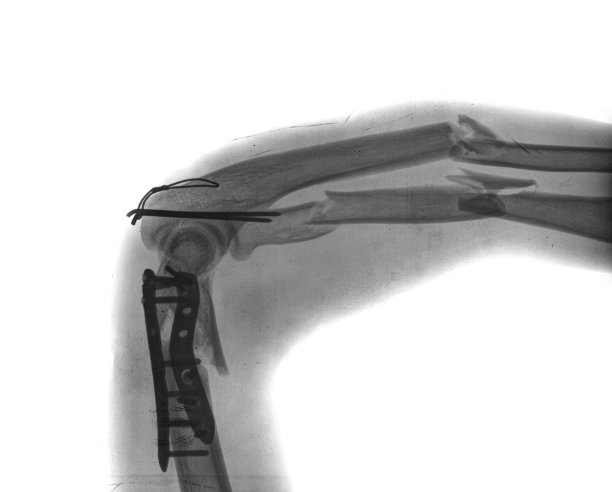 带螺丝断臂图片下载