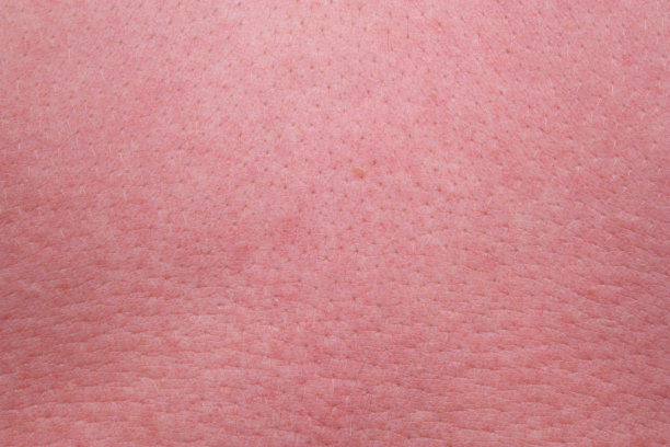 强烈的晒伤皮肤图片下载