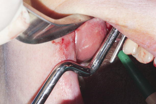 真正的牙齿手术图片下载