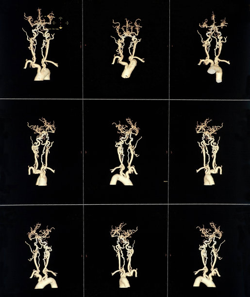 CT血管造影扫描颈椎三维计算机图像图片下载