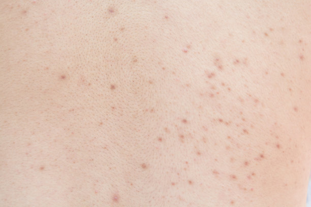 背部痤疮图片下载