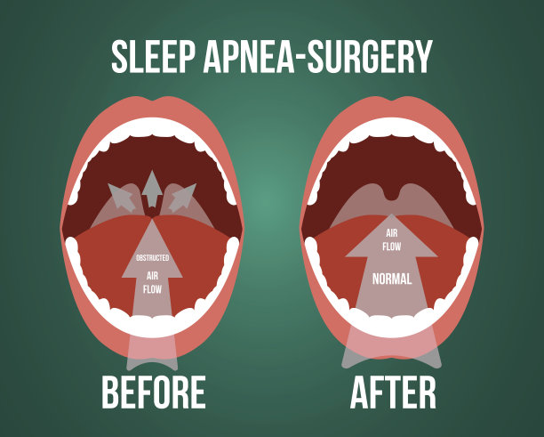 阻塞性睡眠呼吸暂停手术矢状图。图片下载