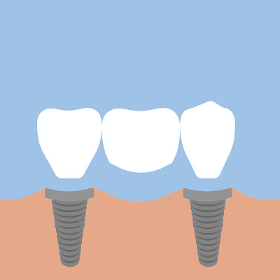 牙桥。平面设计图片下载
