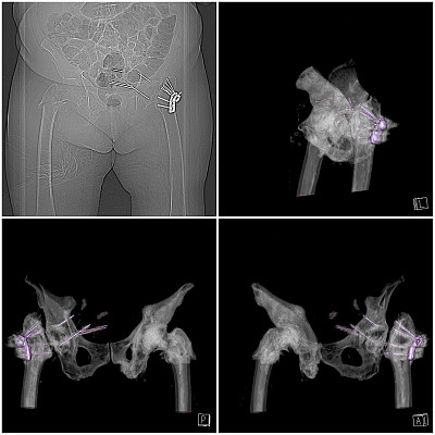术后髋关节骨折图片下载