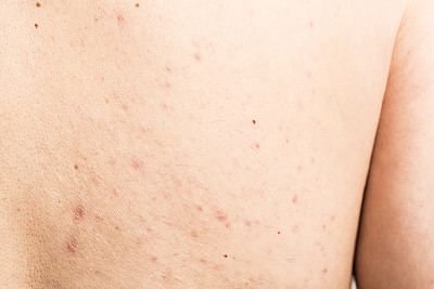 男人背上的粉刺素材图片