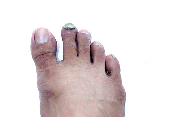 断脚指甲图片下载