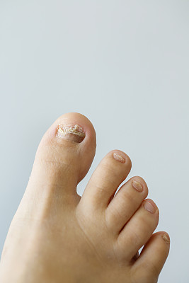 灰指甲图片下载