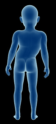 脊椎侧弯儿童的身体图片下载