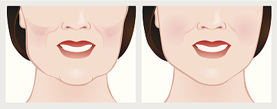 在治疗前和治疗后使用皮肤填充物提容。图片下载