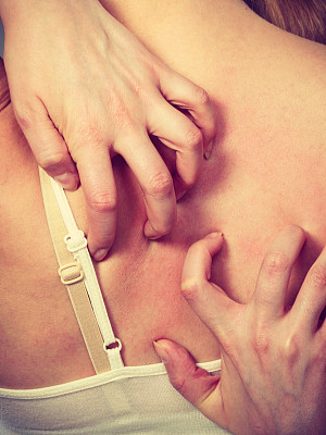 一个女人用过敏皮疹挠着她发痒的后背图片下载