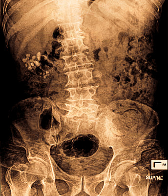 用X光检查肾结石图片下载