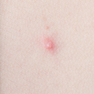 人类皮肤上的痤疮特写图片下载