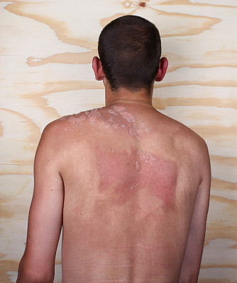 有害紫外线的影响图片下载