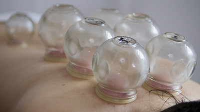 藏药-一个女人背上很多玻璃杯子图片下载