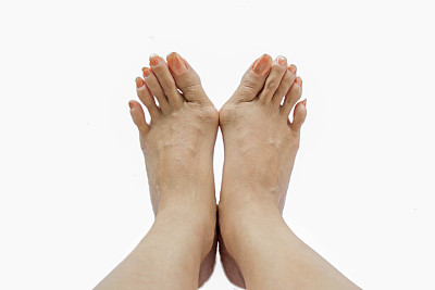 拇外翻，足部拇外翻图片下载