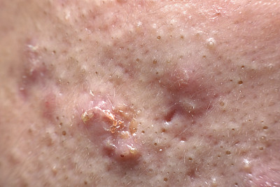 面部痤疮发炎和感染。图片下载