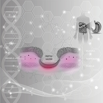 胃溃疡胃的消化性溃疡素材图片