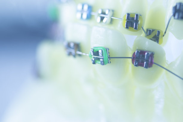 牙齿矫正牙医教学模型牙齿塑料和金属支架对准，以矫正每颗牙齿。图片下载