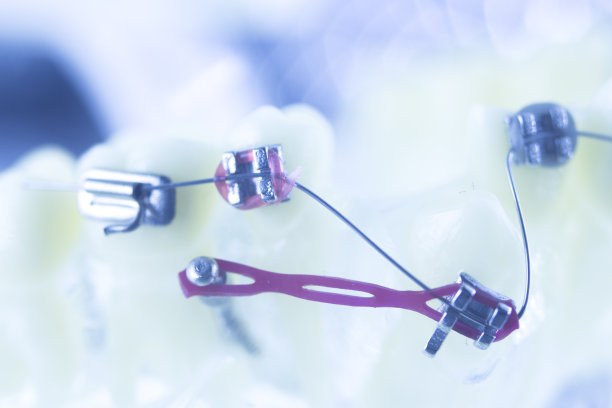 牙齿矫正牙医教学模型牙齿塑料和金属支架对准，以矫正每颗牙齿。图片下载