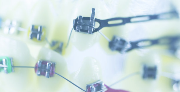 牙齿矫正牙医教学模型牙齿塑料和金属支架对准，以矫正每颗牙齿。图片下载