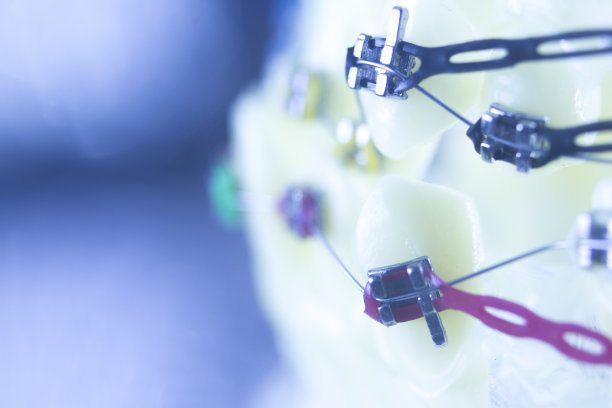 牙齿矫正牙医教学模型牙齿塑料和金属支架对准，以矫正每颗牙齿。图片下载