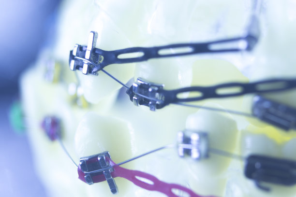 牙齿矫正牙医教学模型牙齿塑料和金属支架对准，以矫正每颗牙齿。图片下载