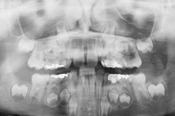 牙齿x光图片下载