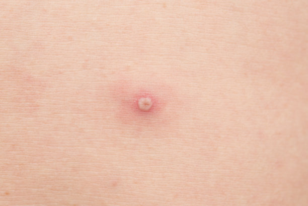 粉刺皮肤上的图片下载