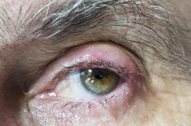 眼睛大麦感染图片下载