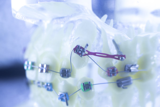 牙齿矫正牙医教学模型牙齿塑料和金属支架对准，以矫正每颗牙齿。图片下载