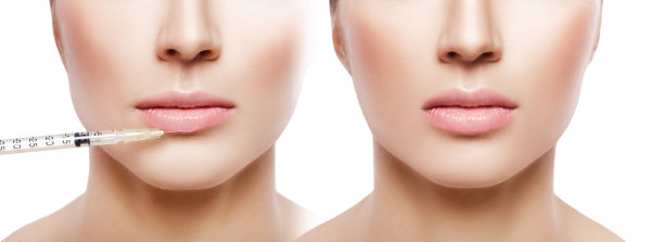 正在嘴唇上注射的女人。图片下载