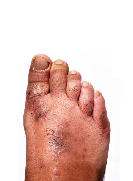 人的脚部是一种真菌性皮肤病变图片下载