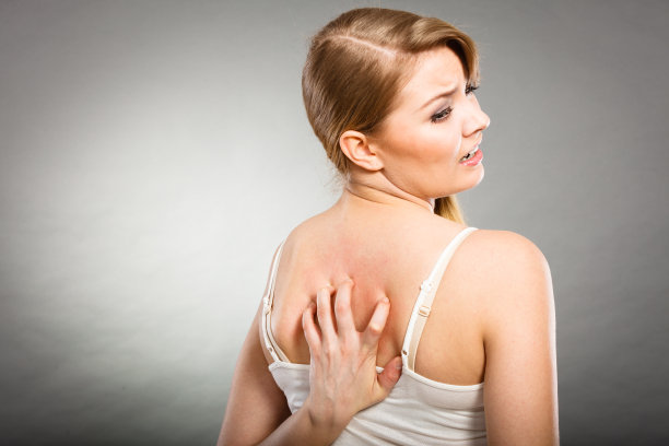 一个女人用过敏皮疹挠着她发痒的后背素材图片