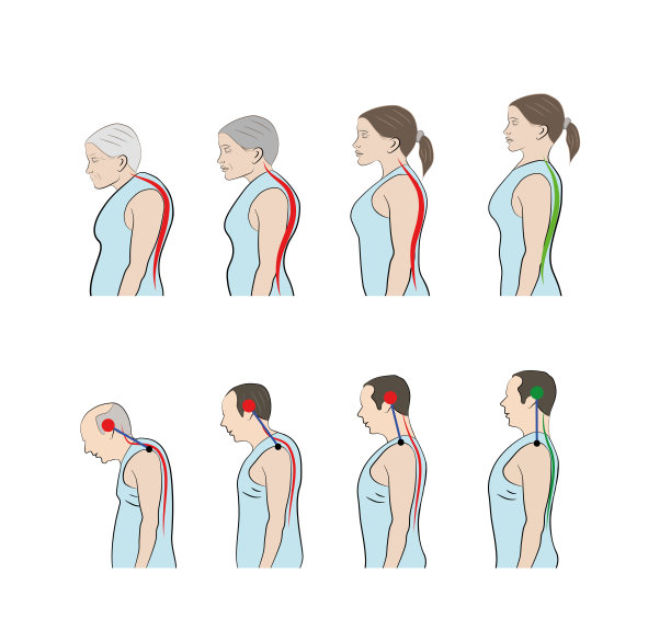 随着年龄的增长出现弯腰的姿势，男性和女性的脊柱弯曲度增加。矢量图图片下载