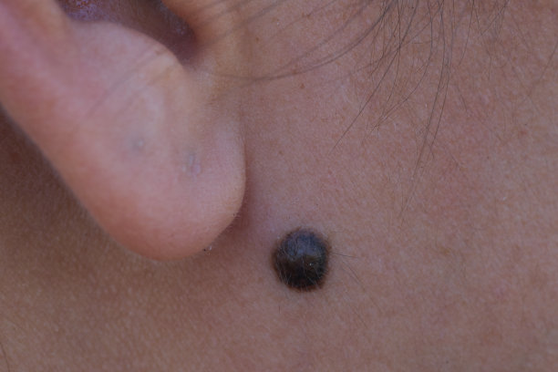 亚洲妇女耳下的痣或痣。图片下载