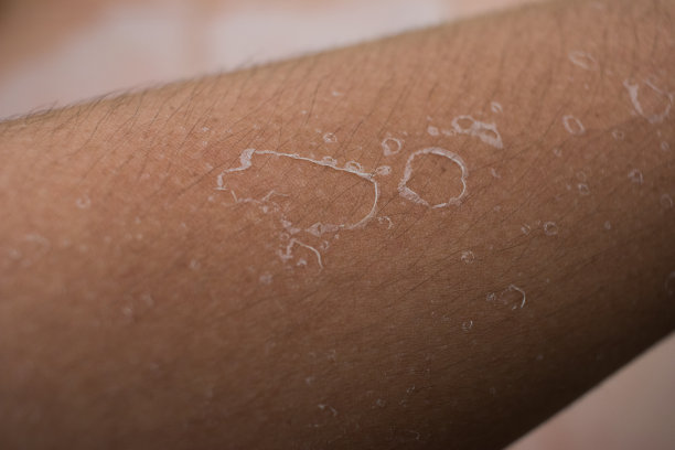 晒伤和凉爽天气后皮肤脱皮图片下载