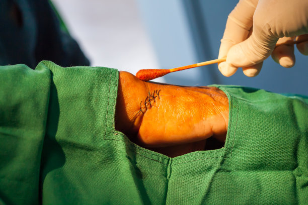 手切伤图片下载