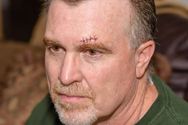 面部受伤成年男性图片下载