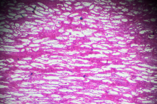 光镜下肾腺癌活检图片下载