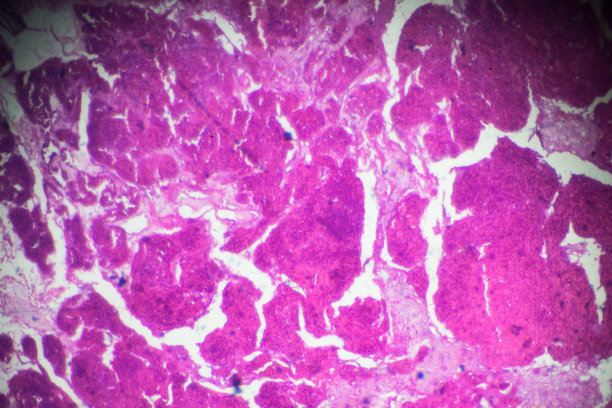 光镜下肾腺癌活检图片下载