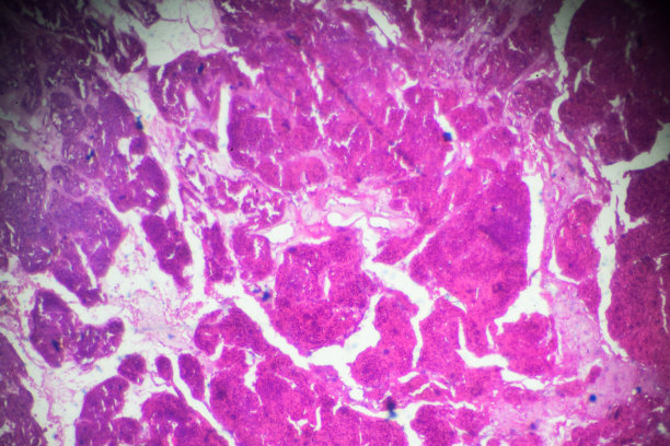 光镜下肾腺癌活检图片下载