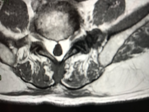 核磁共振硬膜瘤图片下载