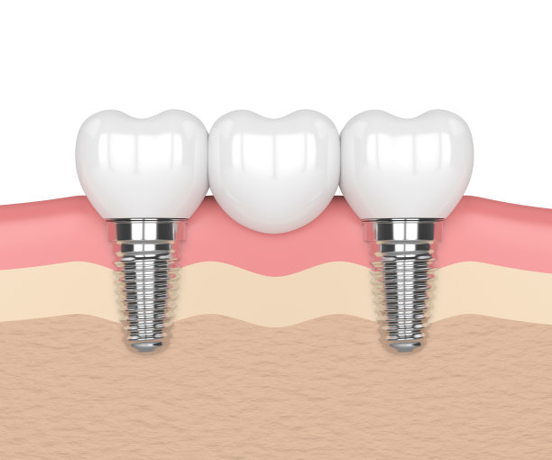 种植体与牙桥的3d渲染图片下载
