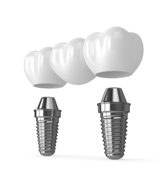 种植体与牙桥的3d渲染图片下载