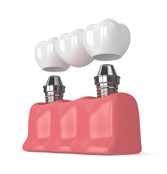 种植体与牙桥的3d渲染图片下载